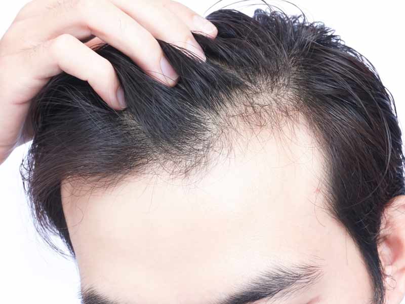 12 روش برای جلوگیری از کم پشتی مو